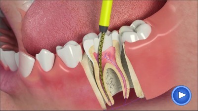 Corona dentale: cos'è, quando si usa e di cosa è fatta