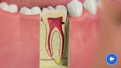 Лечение шейки зуба